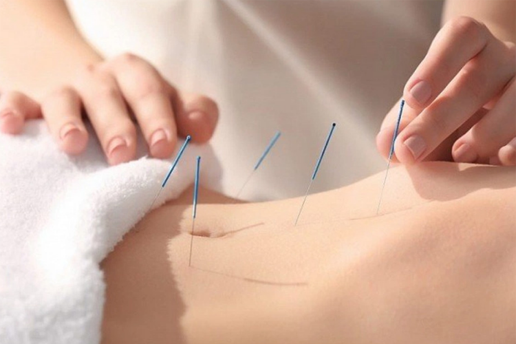 Điện mãng châm điều trị hội chứng dạ dày – tá tràng